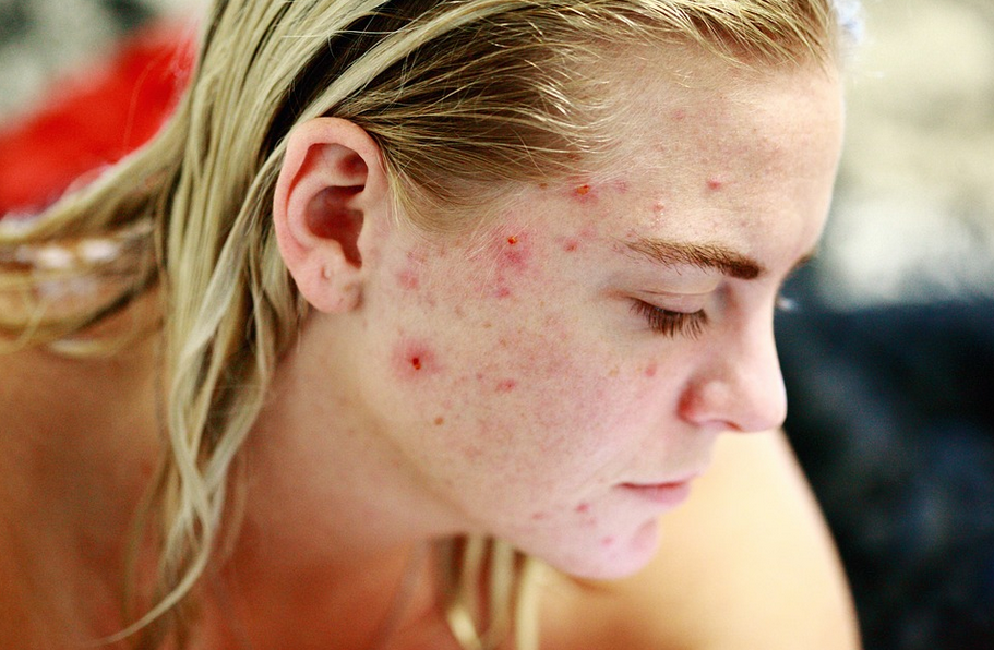 acne